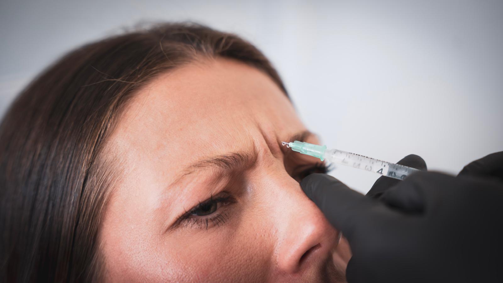 Botox Vorher-Nachher