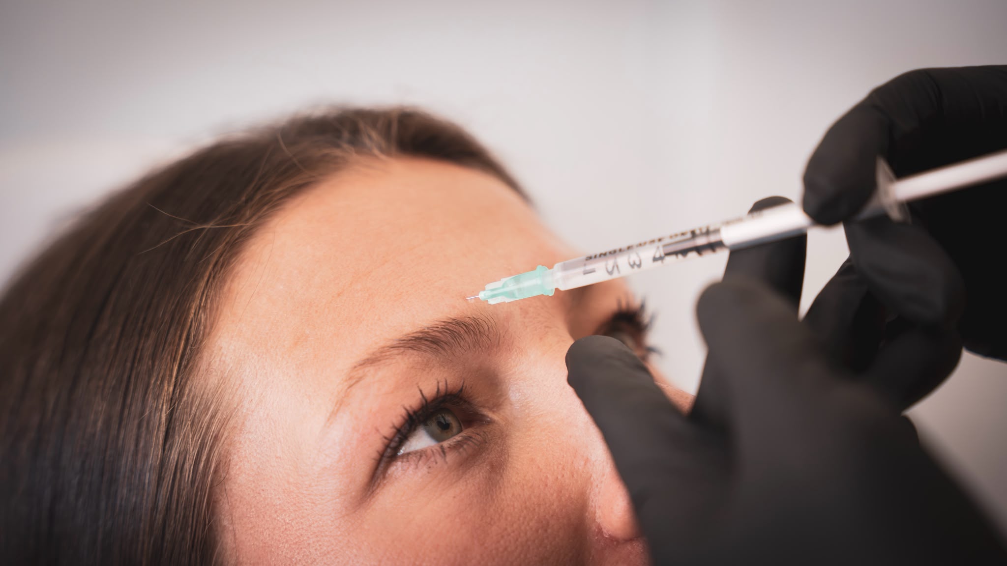 Botox Vorher-Nachher