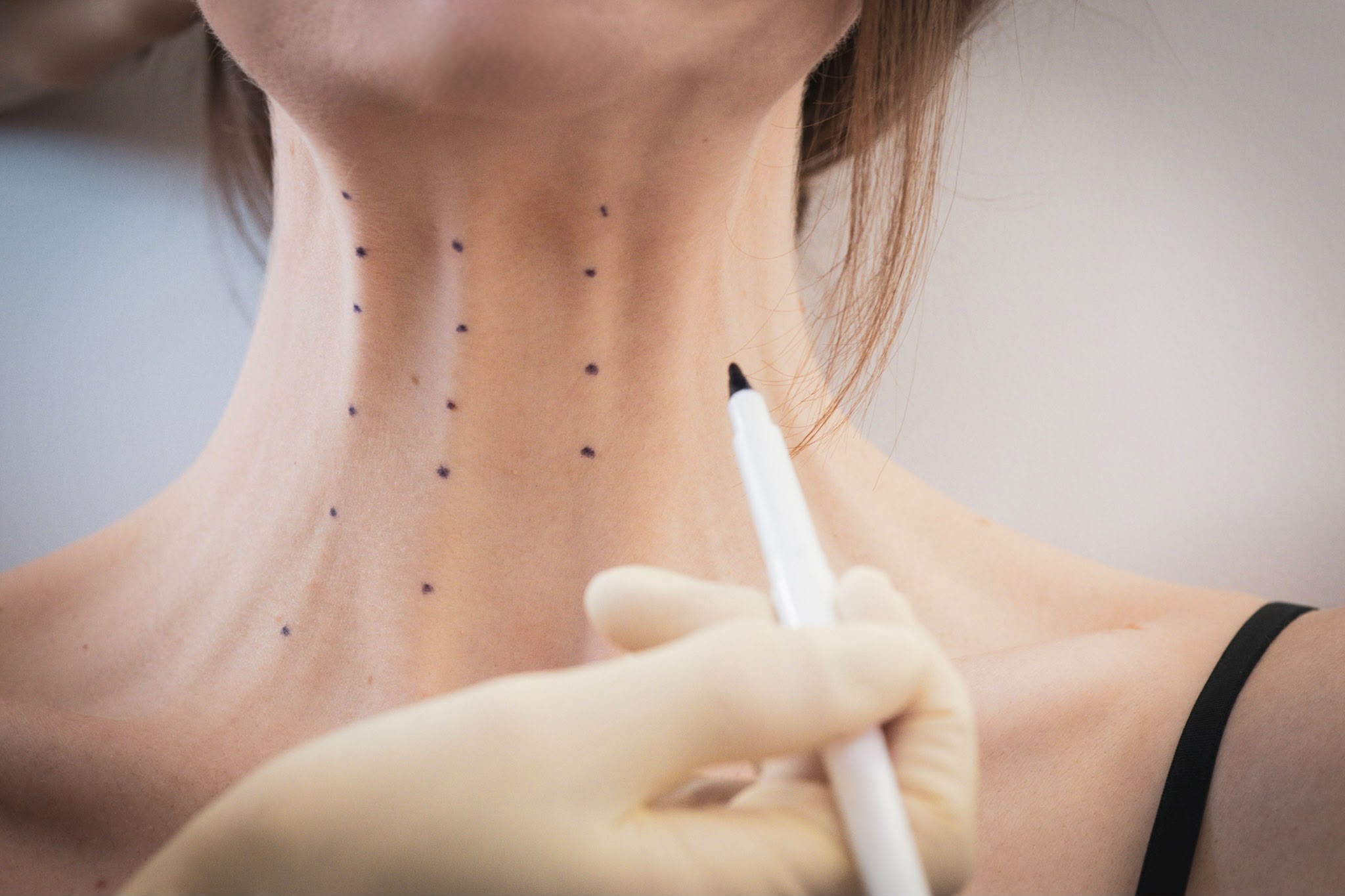 Botox Vorher-Nachher