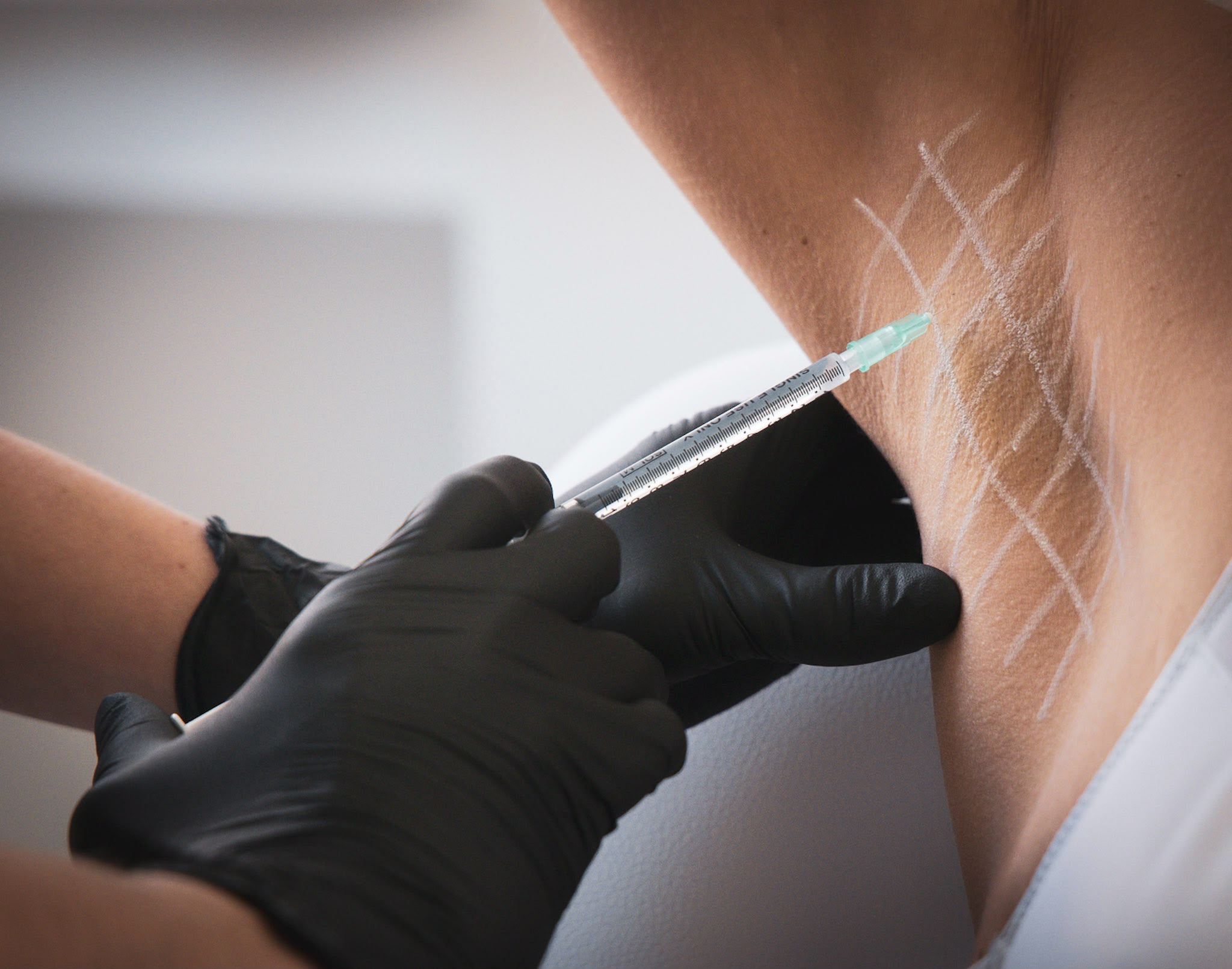 Botox Vorher-Nachher