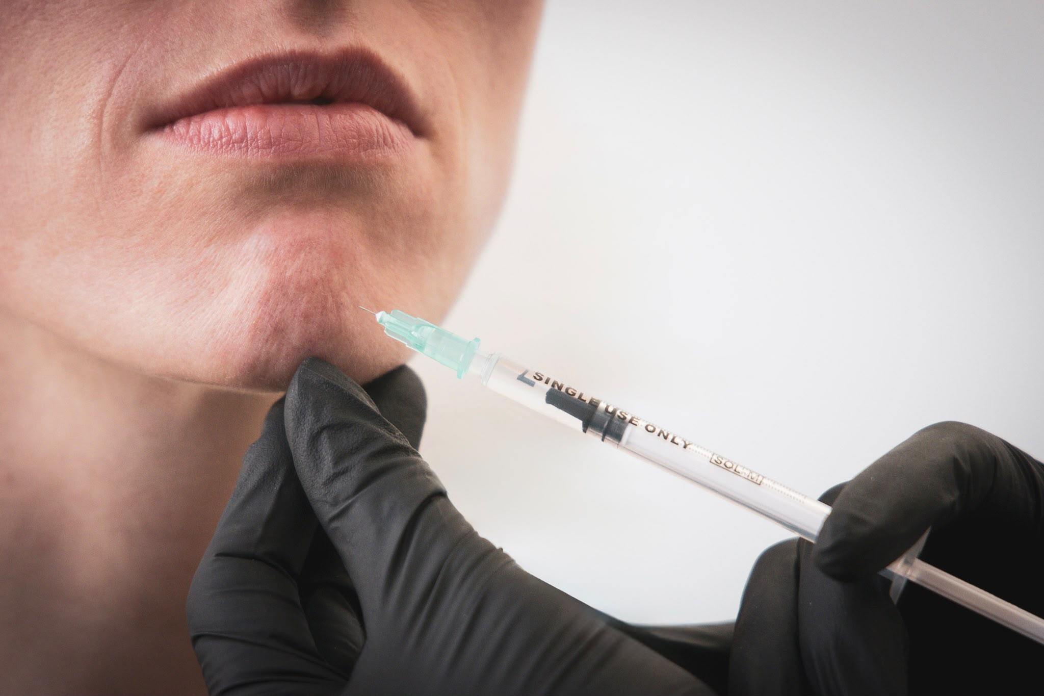 Botox Vorher-Nachher
